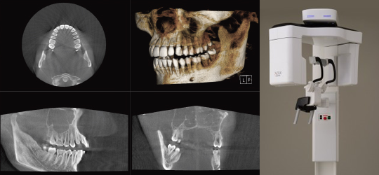 歯科用CT 「X-ERA MF」